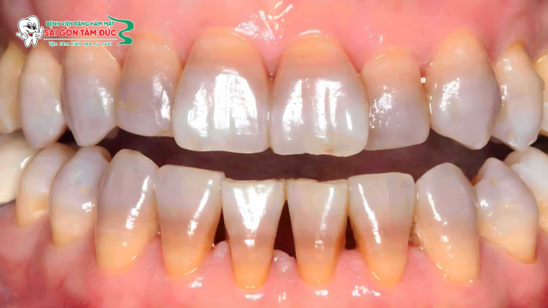 1boc rang su co can lay tuy khong 5 benhvienranghammatsaigontamduc