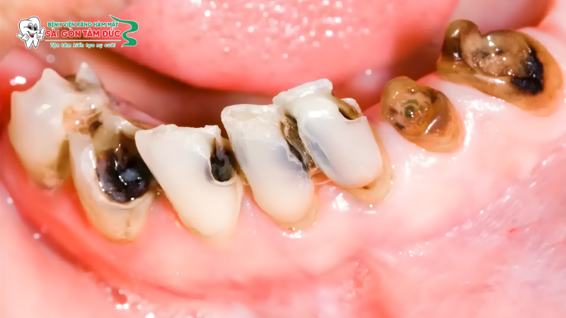 1boc rang su co can lay tuy khong 6 benhvienranghammatsaigontamduc