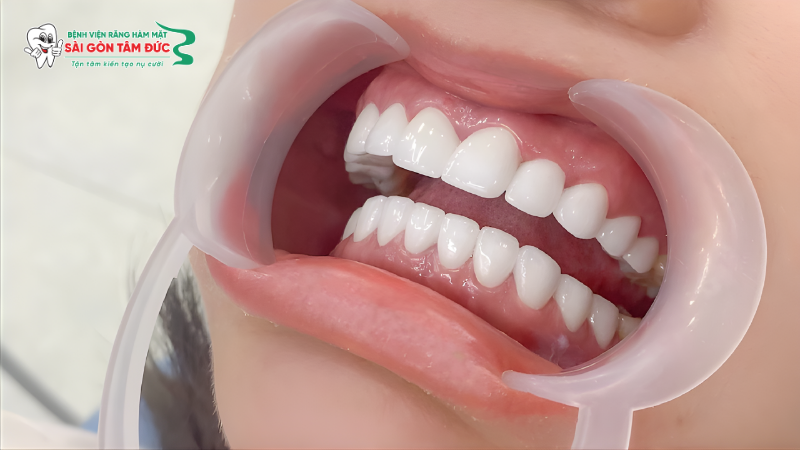 1boc rang su duoc bao lau 1 benhvienranghammatsaigontamduc