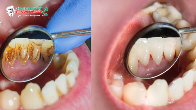 1cao voi rang 3 benhvienranghammatsaigontamduc