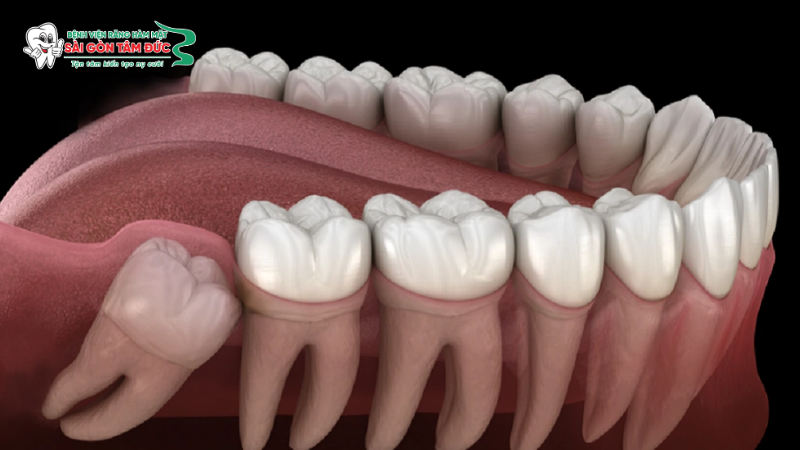 1nho rang khon 2 benhvienranghammatsaigontamduc