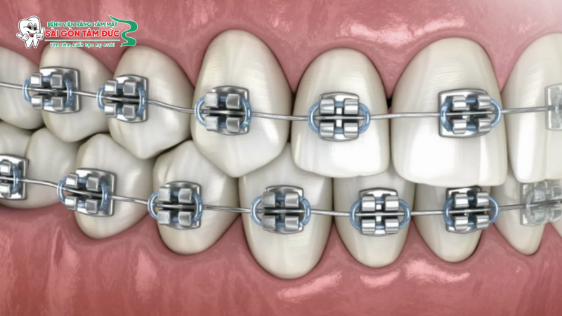 1nieng rang mac cai tu buoc 1 benhvienranghammatsaigontamduc