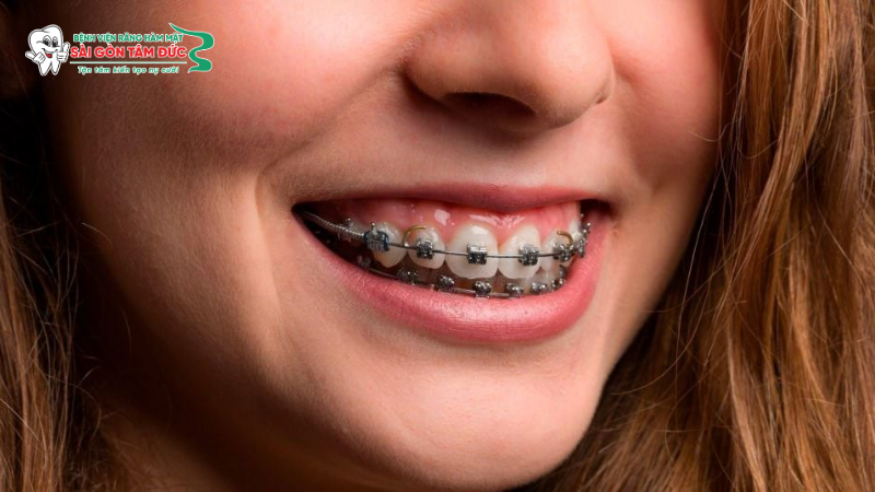 1nieng rang mac cai tu buoc 2 benhvienranghammatsaigontamduc