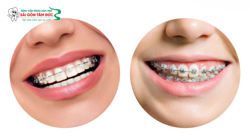 1nieng rang mac cai tu buoc 4 benhvienranghammatsaigontamduc