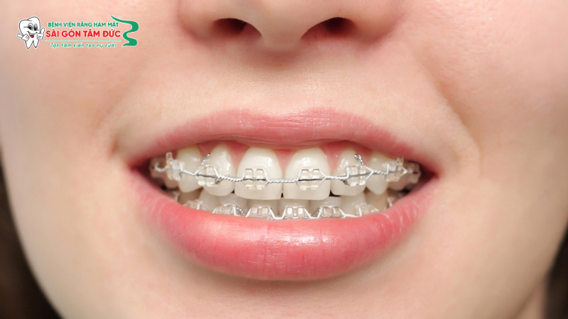 1nieng rang mac cai tu buoc 5 benhvienranghammatsaigontamduc