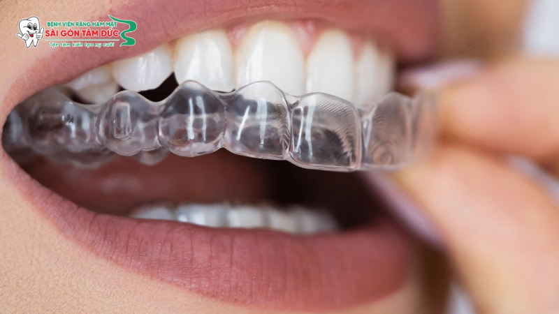 1nieng rang trong suot 1 benhvienranghammatsaigontamduc