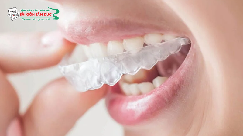 1nieng rang trong suot 3 benhvienranghammatsaigontamduc