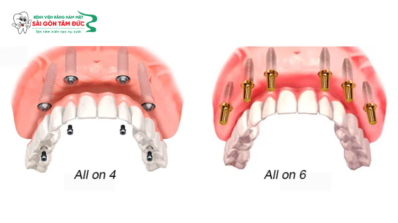 1phuc hinh rang su tren implant 4 benhvienranghammatsaigontamduc
