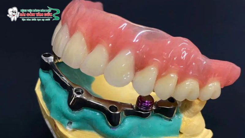 1phuc hinh rang su tren implant 5 benhvienranghammatsaigontamduc