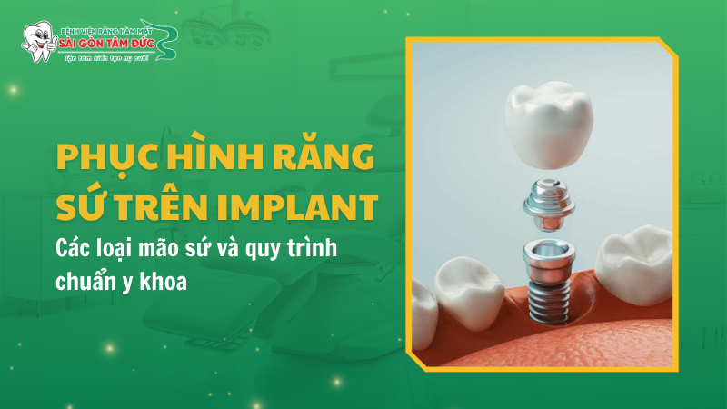 1thumb phuc hinh rang su tren implant benhvienranghammatsaigontamduc