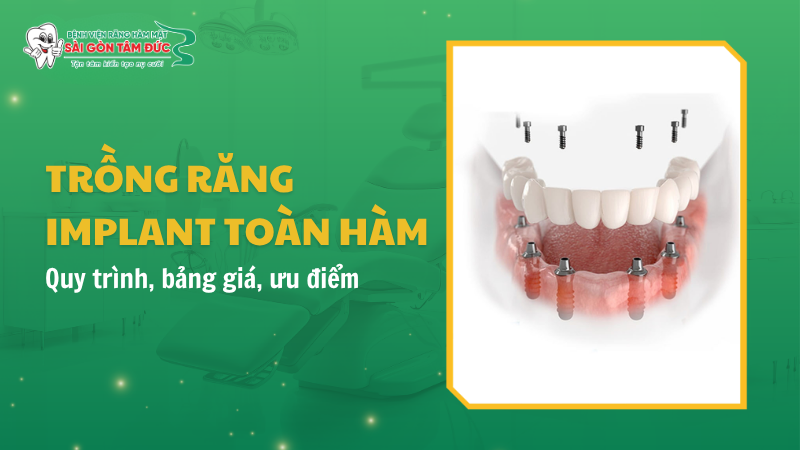 1thumb trong rang implant toan ham benhvienranghammatsaigontamduc