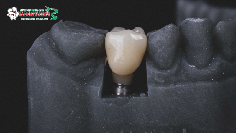 1titanium la gi 2 benhvienranghammatsaigontamduc