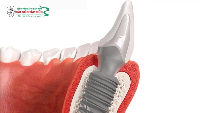 1titanium la gi 4 benhvienranghammatsaigontamduc