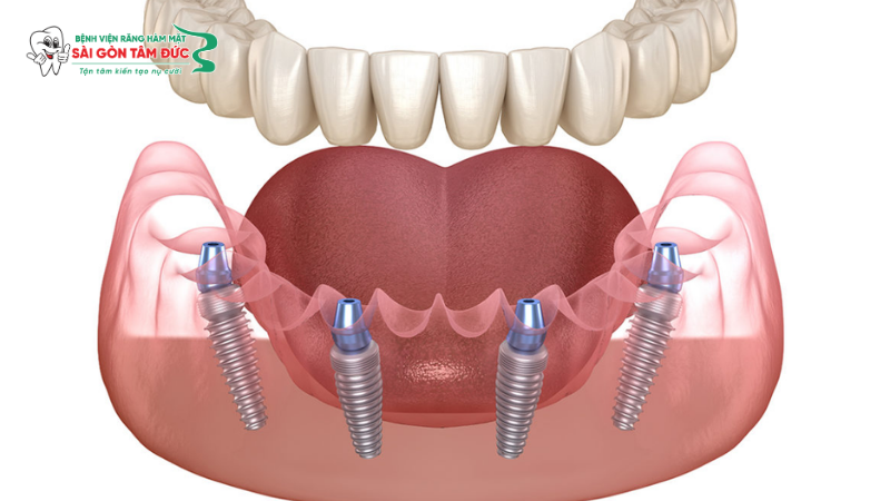 1trong rang implant toan ham 1 benhvienranghammatsaigontamduc