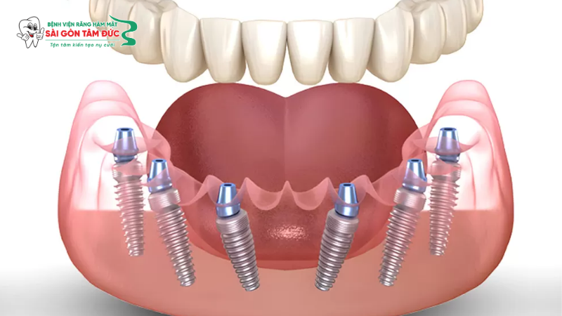1trong rang implant toan ham 2 benhvienranghammatsaigontamduc