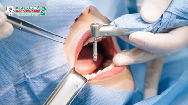 1trong rang implant toan ham 3 benhvienranghammatsaigontamduc