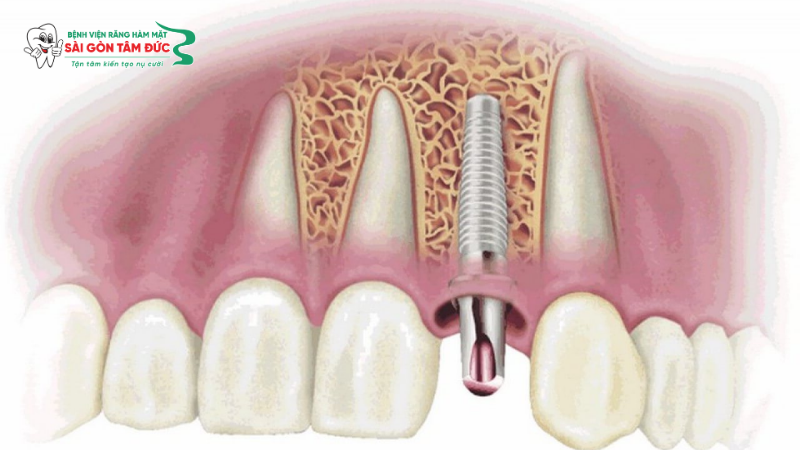 1trong rang implant tuc thi 3 benhvienranghammatsaigontamduc