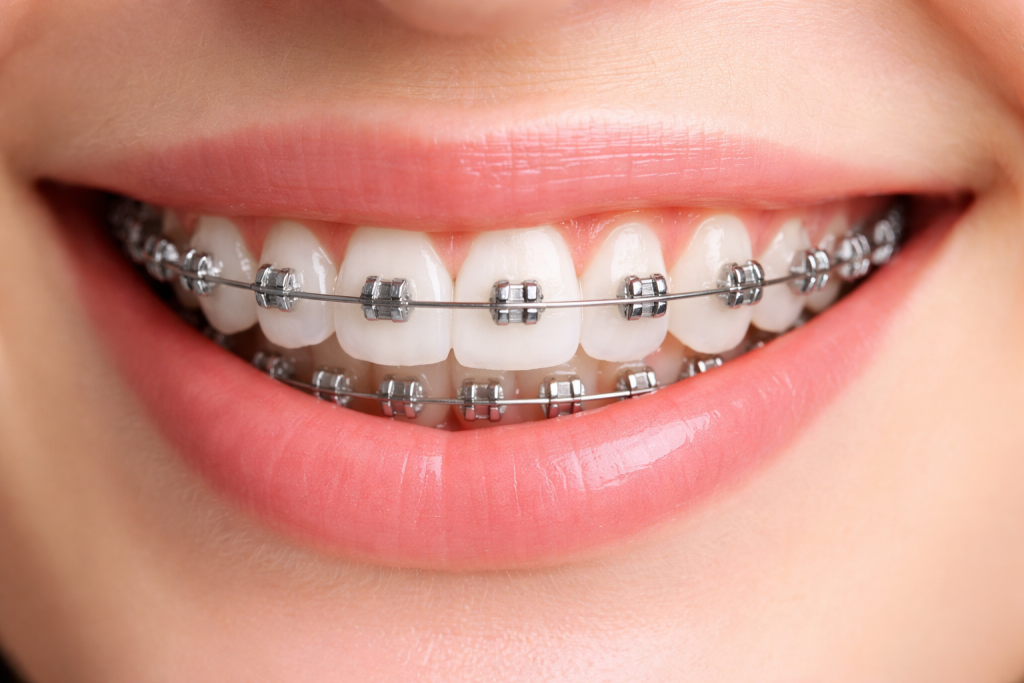 Chỉnh nha - Niềng răng trọn gói, an toàn 2026 3 Nieng rang mac cai kim loai