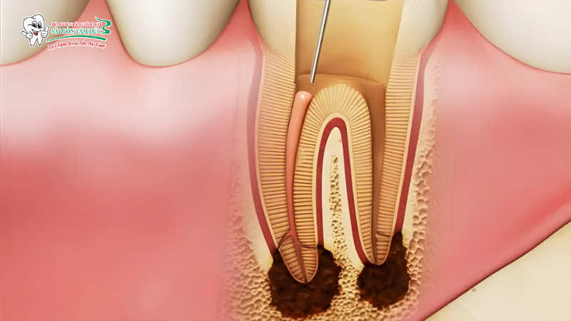 Viêm nhiễm, sưng tấy xảy ra ở vùng tủy răng