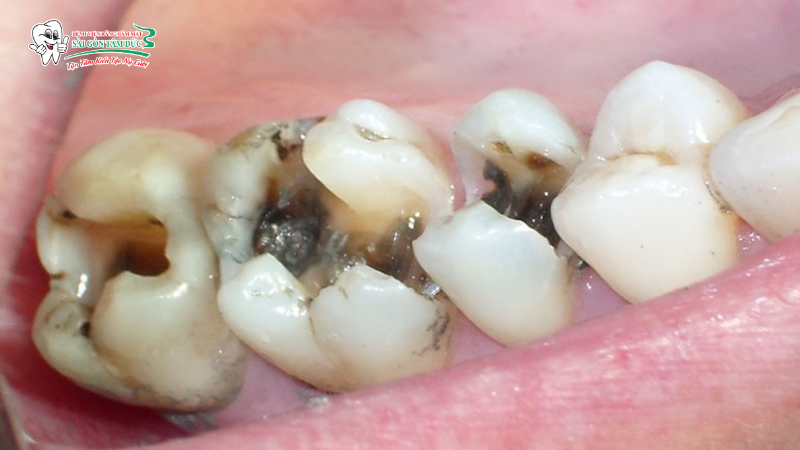 Nơi mô tủy bị chết, phân hủy và mất hoàn toàn chức năng cảm giác, nuôi dưỡng