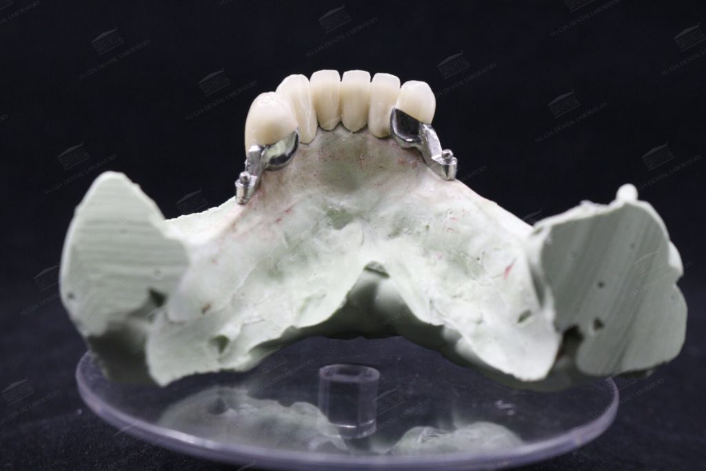 Hàm tháo lắp trọn gói, uy tín, an toàn và bảng giá 2026 5 ham khung lien ket